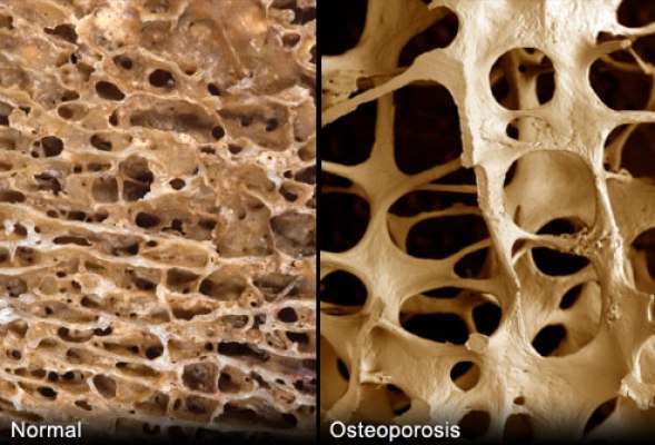 osteoporosis (1)