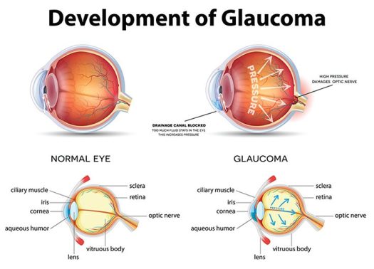 glaucoma-736x530
