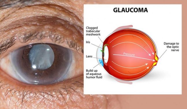 glaucoma2-752x440