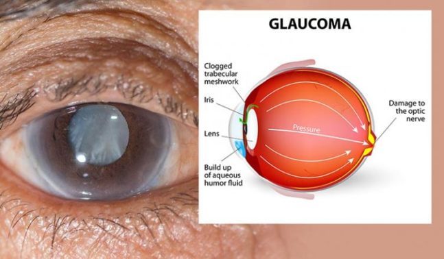 glaucoma2-752x440